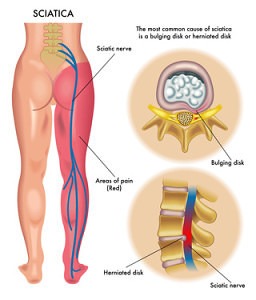 image of Sciatica pain and sciatic nerve