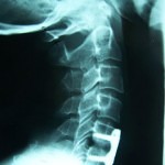 image of xray showing metal plate placed in spinal fusion surgery. 
